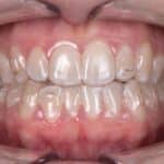 SureSmile对准器和类我和温和的第三类模式