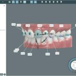 伙伴关系给CandidPro带来视觉治疗计划